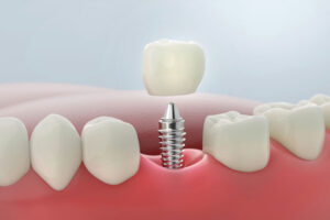 Illustration of a dental implant with crown placement—showing how implants restore missing teeth with a secure, natural-looking solution.