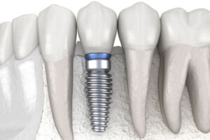 Dental implant illustration showing a titanium post integrated with jawbone—offering a strong, natural-looking solution for missing teeth. Restore your smile today!