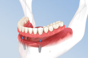 a snap on denture jaw 3d model