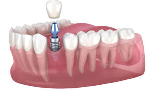 3D illustration of a dental implant with a metal post, abutment, and crown being placed in the lower jaw, surrounded by natural teeth and gums