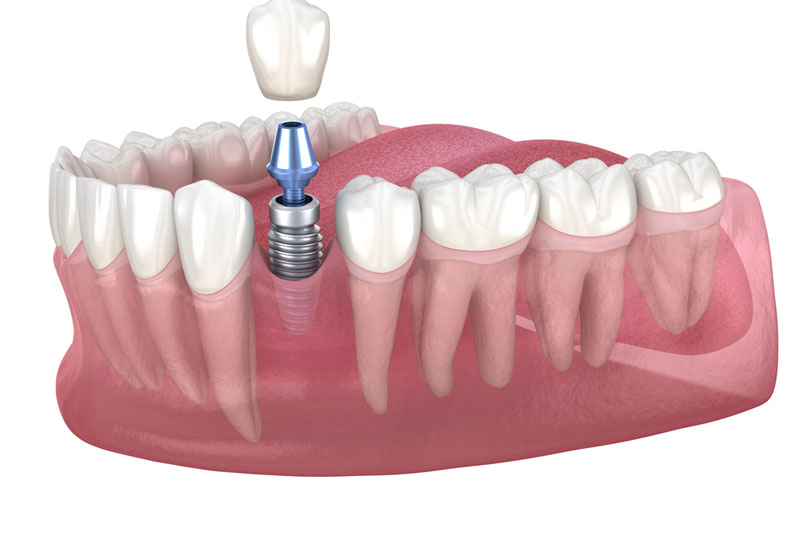 3D illustration of a dental implant with a metal post, abutment, and crown being placed in the lower jaw, surrounded by natural teeth and gums