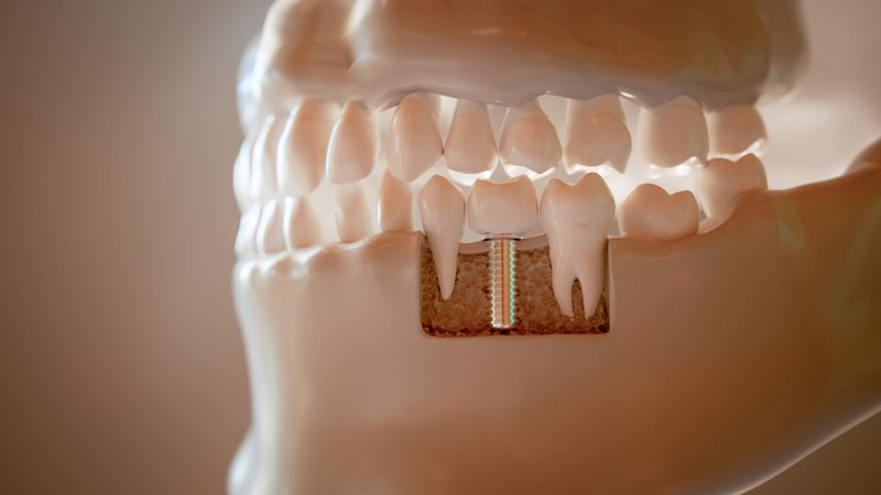 Dental implant, artificial tooth roots into jaw, root canal of dental treatment, gum disease, teeth model for dentist