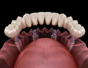 3d lower mouth jaw with dental full mouth dental implants