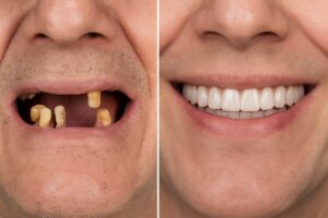 Image showcasing before and after results for implant supported dentures. The before image shows missing and damaged teeth, while the after image shows a full, natural-looking smile with implant supported dentures. No text on image.