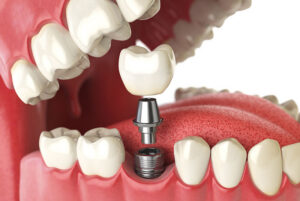 Dental implants