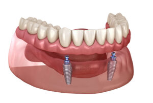 Implant Supported dentures