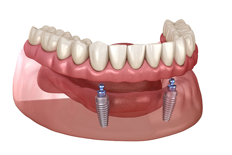 Implant Supported dentures